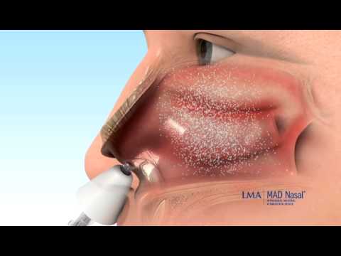 LMA MAD Nasal Intranasal Mucosal Atomization Device Without Syringe