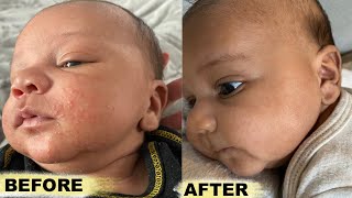 How To Get Rid Baby Acne FAST!