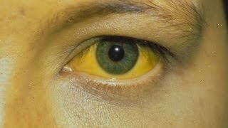 Bilirubine en Icterus