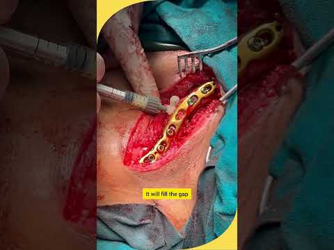 DBM - De-Mineralized Bone Matrix | Dr.RanvijayPathak