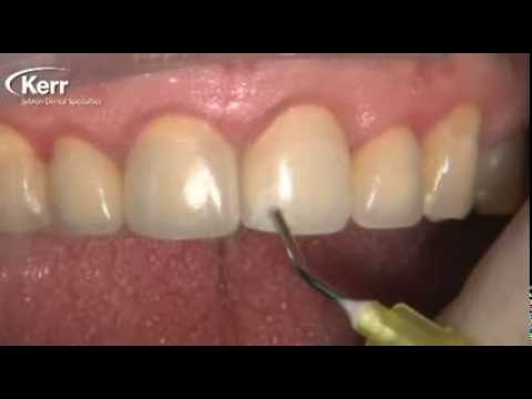 Kerr Vertise Flow Porcelain Repair