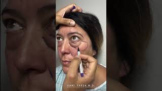 Lower Eye Bag Removal Before and After - Kami Parsa