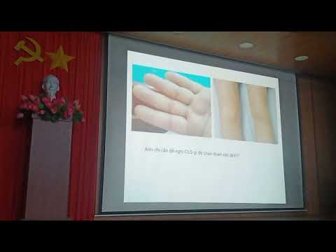 Viêm khớp dạng thấp 3