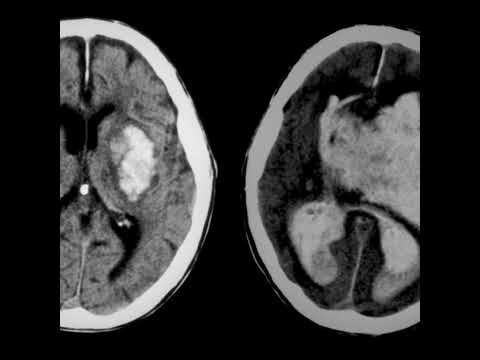 Vidna Obmana - Hemorrhage [full album] (1986) 