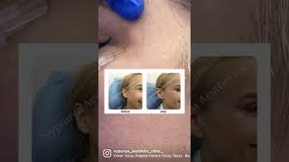 Botox for wrinkles- Crows feet - Best Botox treatment in Bangalore- Nypunya Aesthetic Clinic