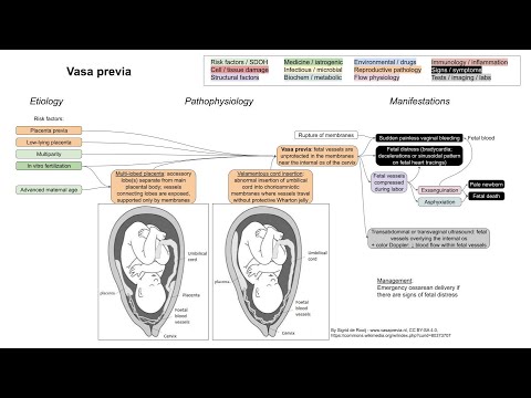 Vasa previa (mechanism of disease)