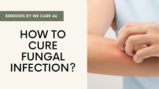 How to Cure Fungal Infection or Ringworm | 13 Remedies