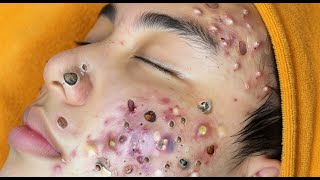 Loan Nguyen Acne Treatment 17m