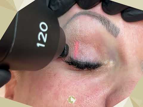 Lidstraffung ohne OP  - Fraktionierter CO2 Laser  - Triemer Aesthetics - Dresden, Sachsen