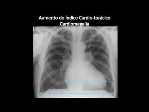Sinais radiológicos da insuficiência cardíaca no raio-x de tórax