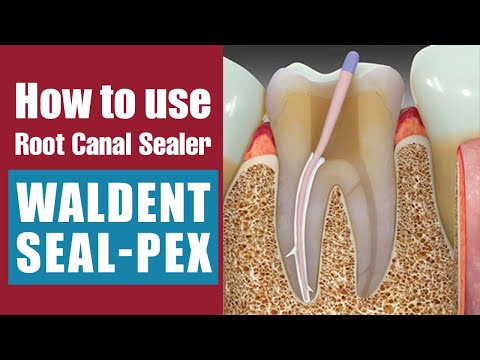 How to use Root Canal Sealer | Waldent Seal-Pex