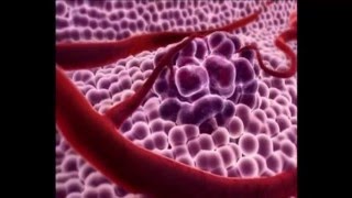 What Is Prostate Cancer?