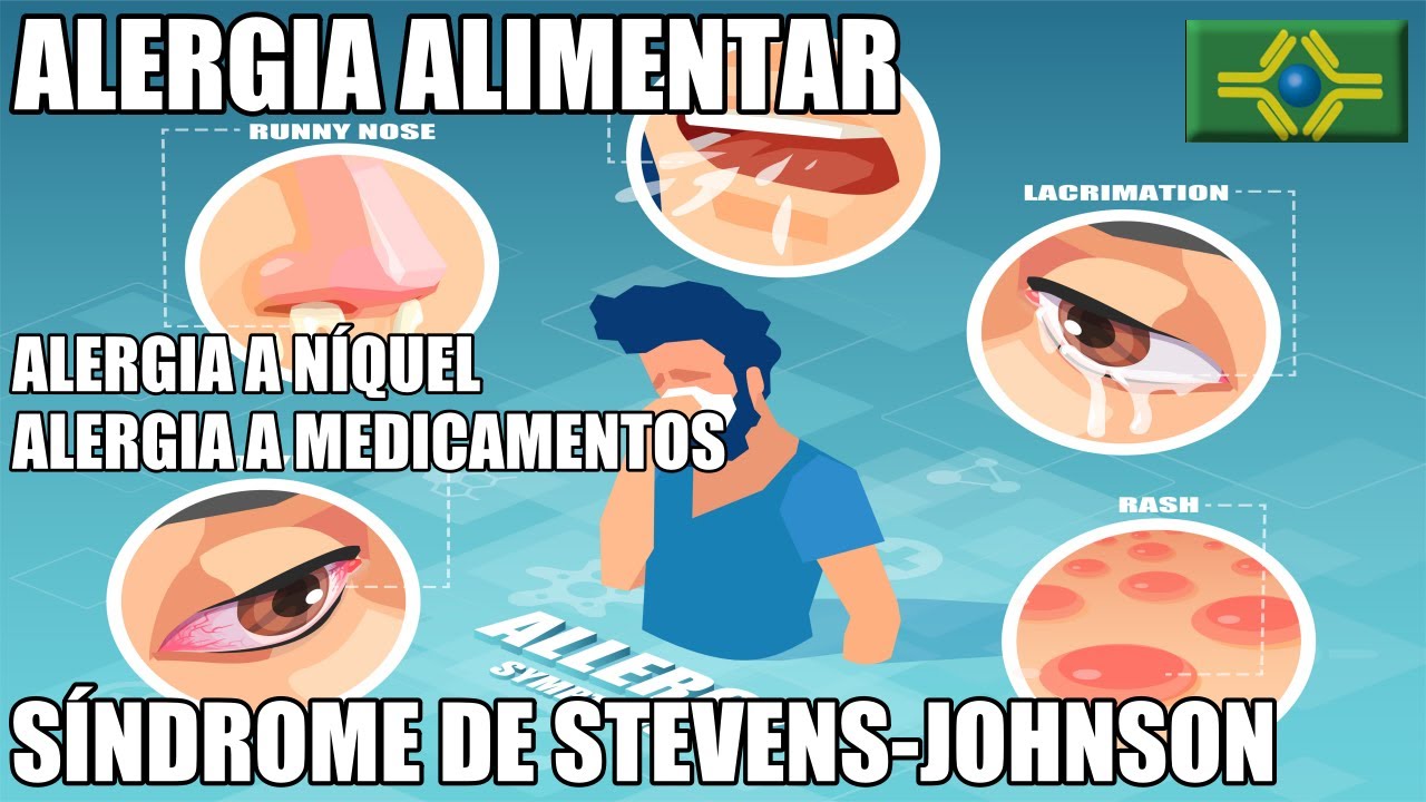 ALERGIA ALIMENTAR | SÍNDROME DE STEVENS-JOHNSON | Alergia a Níquel | Alergia a Amoxicilina | Asma