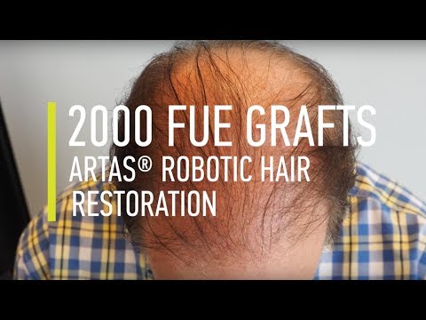 Hair transplant: 2000 FUE Grafts ARTAS® Robotic Hair...
