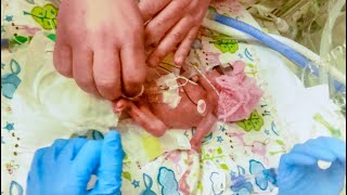 This baby was born at 24 weeks with feet the size of a penny. She beat all odds