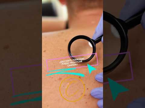 Quitar verrugas provoca cancer ?