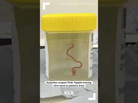 Australian surgeon removes ‘happily-moving’ alive worm from patient’s brain