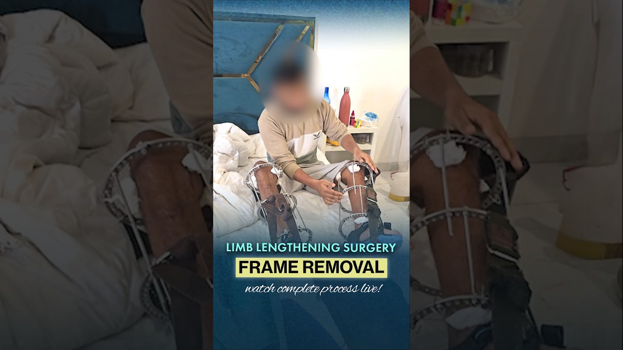 Frame Removal After Limb Lengthening Surgery in India | Recovery Milestone | Heights Plus
