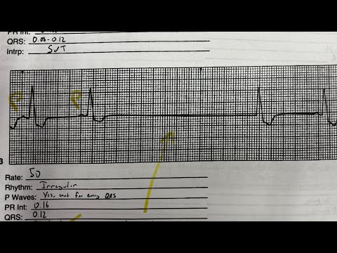 Sinus node dysfunction: pause vs arrest vs exit block