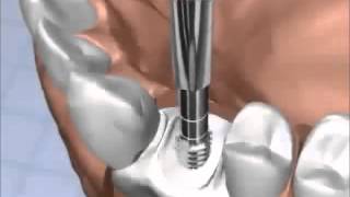 Zubni implanti - animacija ugradnje