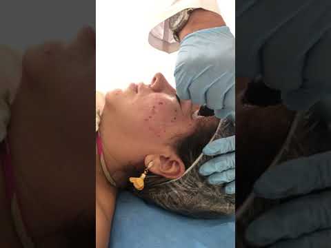 Dermopen - Dermatólogo Cali - Recupera y desmancha la piel - Alopecia