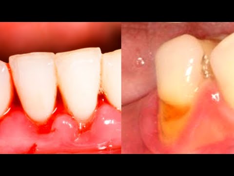 Do You Have Gum Recession or Gum Disease - What's The Difference?