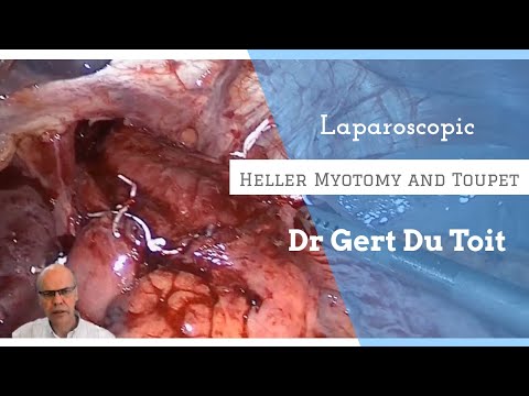 Laparoscopic Heller Myotomy and Toupet Fundoplication for Achalasia