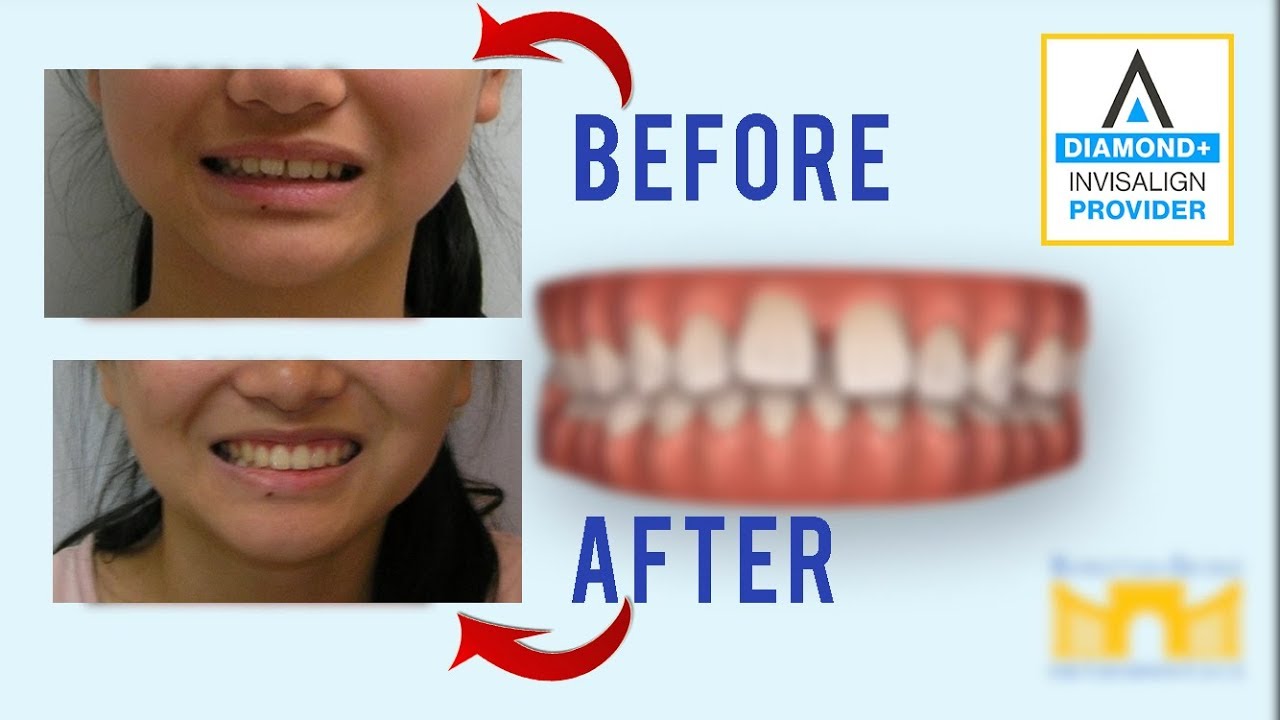Invisalign Before and After: Gap in Teeth