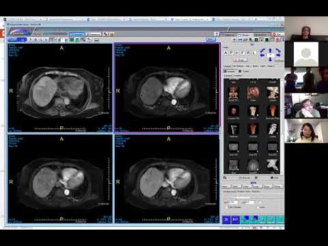 Targetoid enhancement pattern pitfall - Victoria Chernyak | HCC