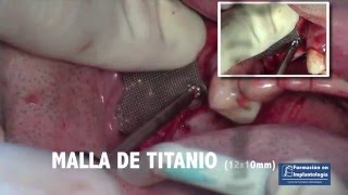 Resolución Sinusitis aguda en elevación de seno  -  complicaciones implantología oral