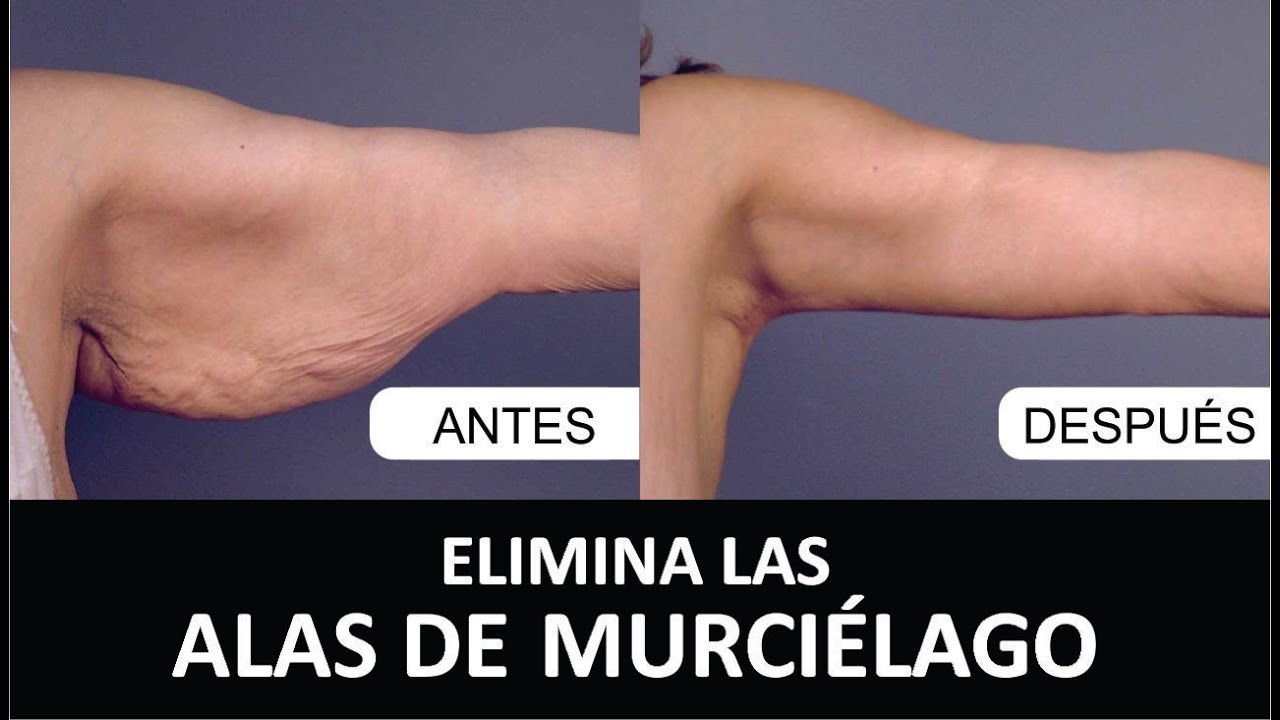 Watch CIRUGÍA DE BRAZOS (BRAQUIOPLASTÍA) - DR. ALBERTO CALVO Now CIRUGÍA DE BRAZOS (BRAQUIOPLASTÍA) - DR. ALBERTO CALVO