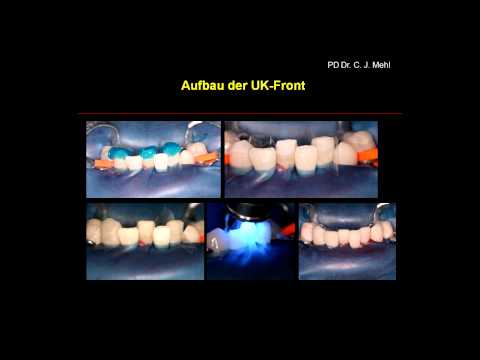 Veneers, Kronen und Brücken: Behandlungsablauf mit Vorher-Nachher-Bildern