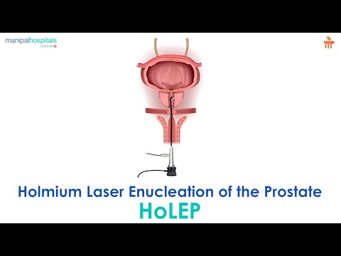 What is Holmium Laser Enucleation of the Prostate? l Manipal Hospitals Bengaluru