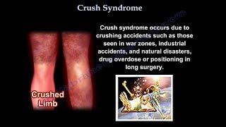Crush Syndrome - Everything You Need To Know - Dr. Nabil Ebraheim