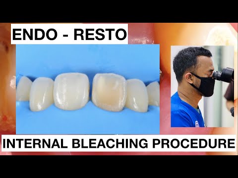Internal Bleaching Teeth Discoloration + Direct Restoration