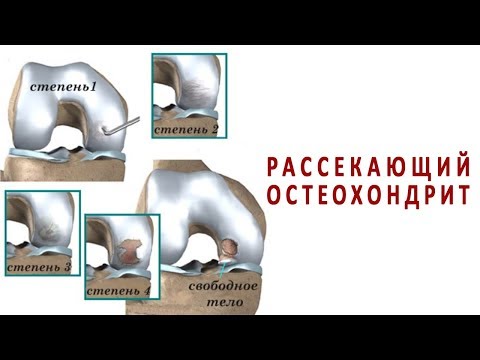 Причины и лечение рассекающего остеохондрита