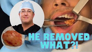 He Removed What?? Procedure For A Slimmer Face
