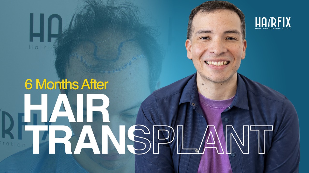 6 Months After My Hair Transplant | Bryant Godoy’s Hairfix Journey