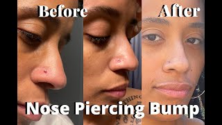How to get rid of a nose piercing bump - My Journey