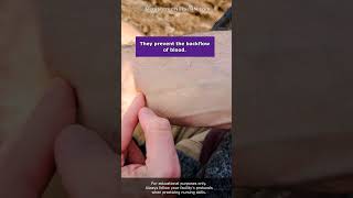 Hitting Vein Valves When Starting IVs or Drawing Blood (Venipuncture) #shorts