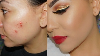 How to Cover Acne & Scars with Makeup ! Cystic Acne & Acne Scars !