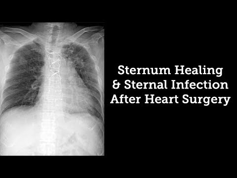 Sternum Healing & Sternal Infection Rates After Heart Surgery with Dr. Steve Bolling