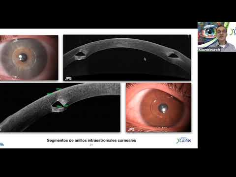 OCT segmento anterior