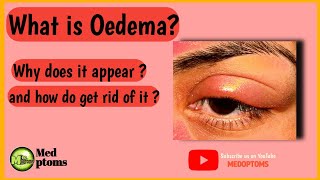 Oedema of  eyelid | Swollen eye!!(Stye, Chalazion, Hordeolum, cellulitis, dermatitis & lid abscess)
