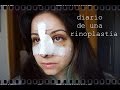 Diario De Una Rinoplastia Días 4 Y 5