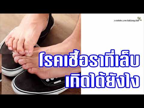 ปลิงจากราคาโรคสะเก็ดเงิน คล้ายกับโรคสะเก็ดเงิน