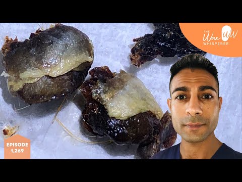 1,269 - Difficult Grade II Keratosis Obturans Removal