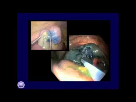 Endoskopowa polipektomia z asystą laparoskopową - minimalnie inwazyjna chirurgia okrężnicy