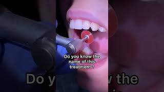 Enameloplasty after Braces - Dental Cosmetic procedure - Tooth Time Family Dentistry New Braunfels
