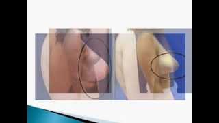 הגדלת שדיים - אבישי וינברגר (מנתח פלסטי) מסביר על הגדלת חזה